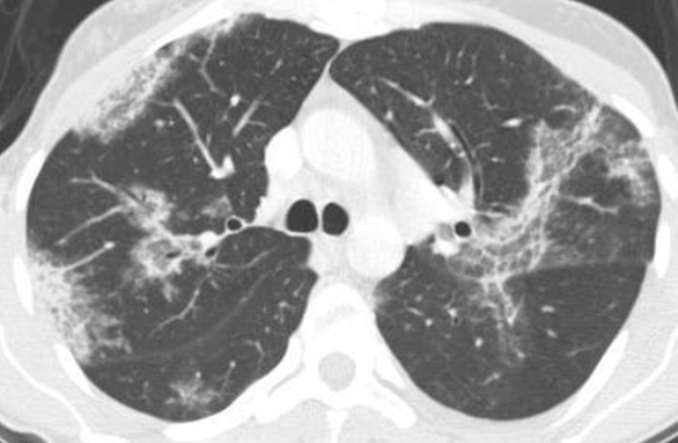 呼吸困難に関する話題がSNSで拡散