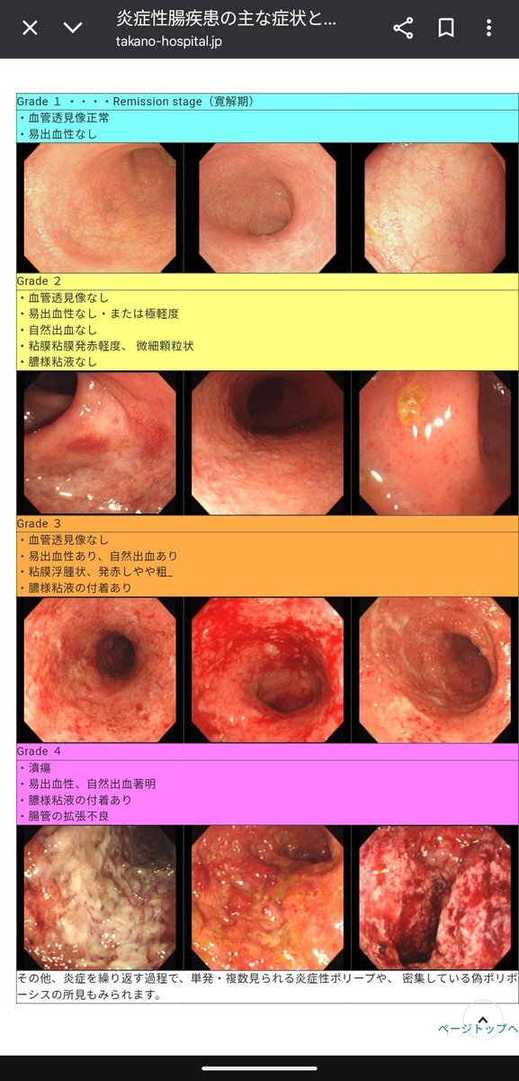 安倍元首相死去後、潰瘍性大腸炎に関する誤解が広がる