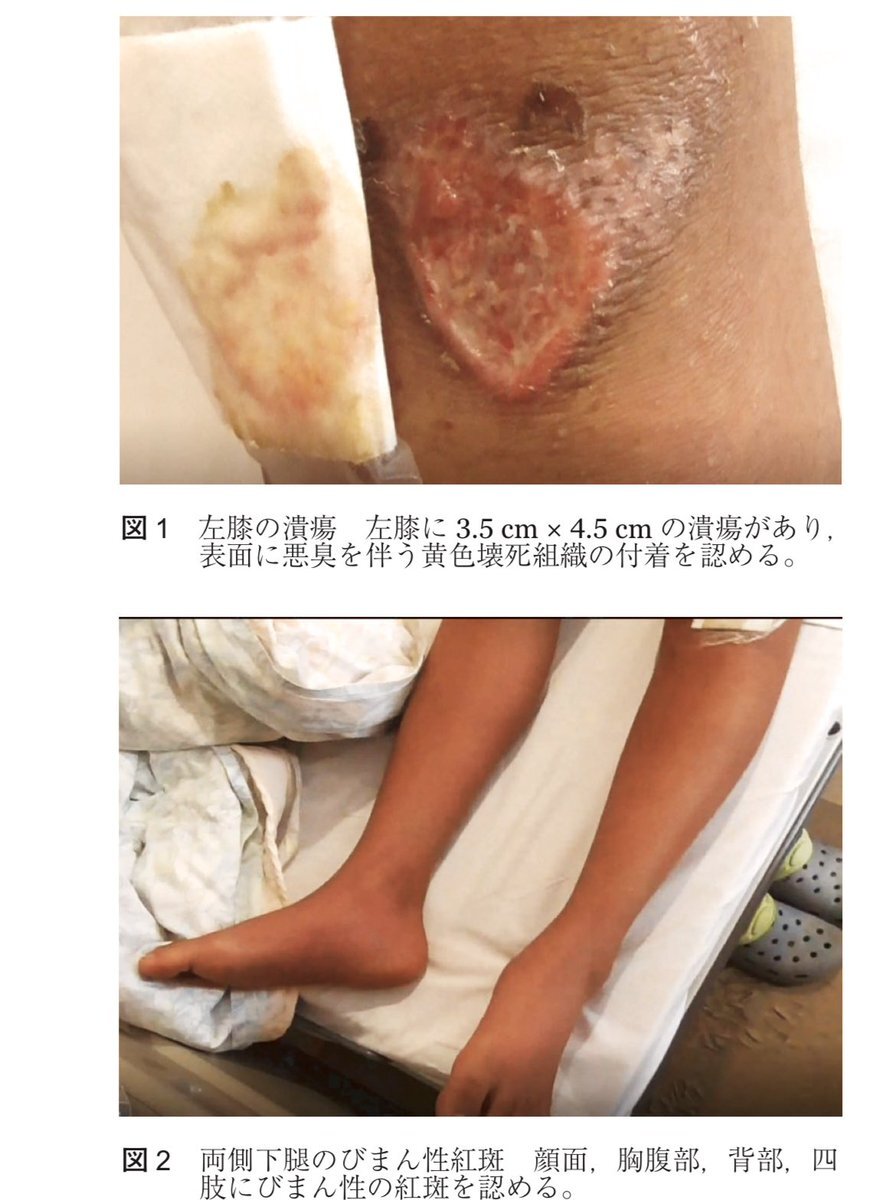 キズパワーパッド、湿潤療法：正しい使い方と注意点