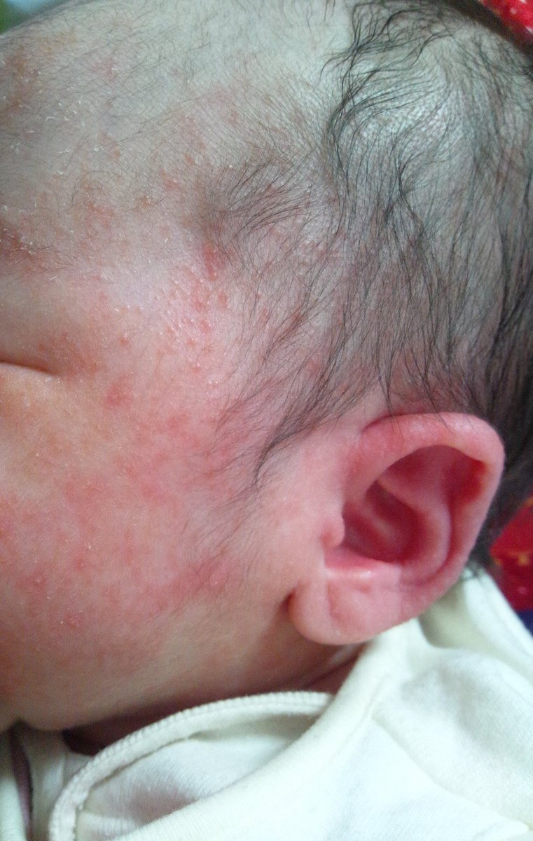 乳児湿疹治療でステロイド外用薬、議論沸騰