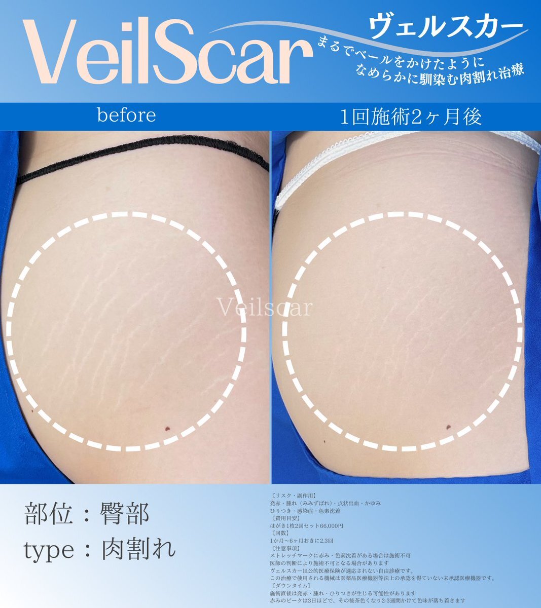 脂肪吸引に関する話題がSNSで盛り上がり